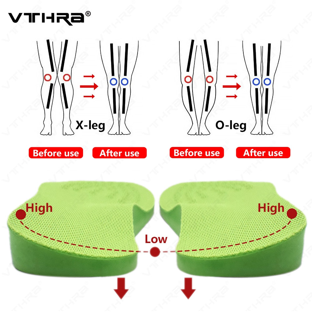 O/X-Leg Orthopedic Insoles